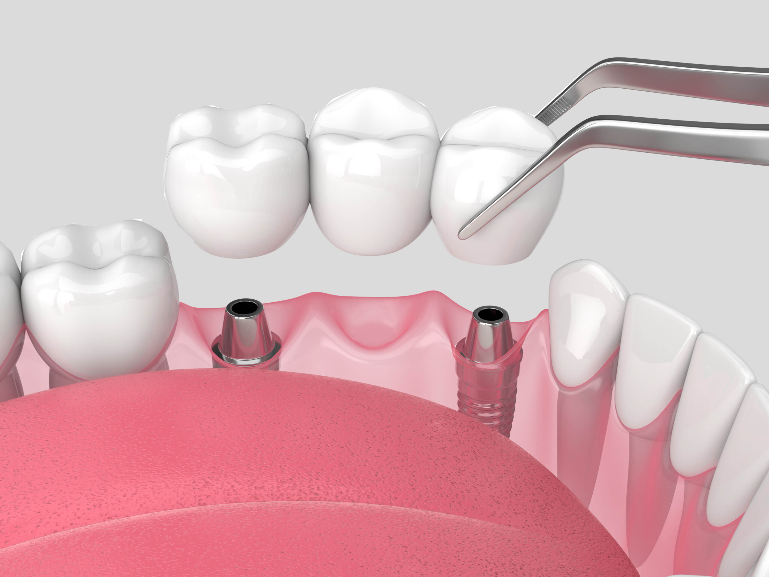 Jaw with implants supporting dental bridge over white background