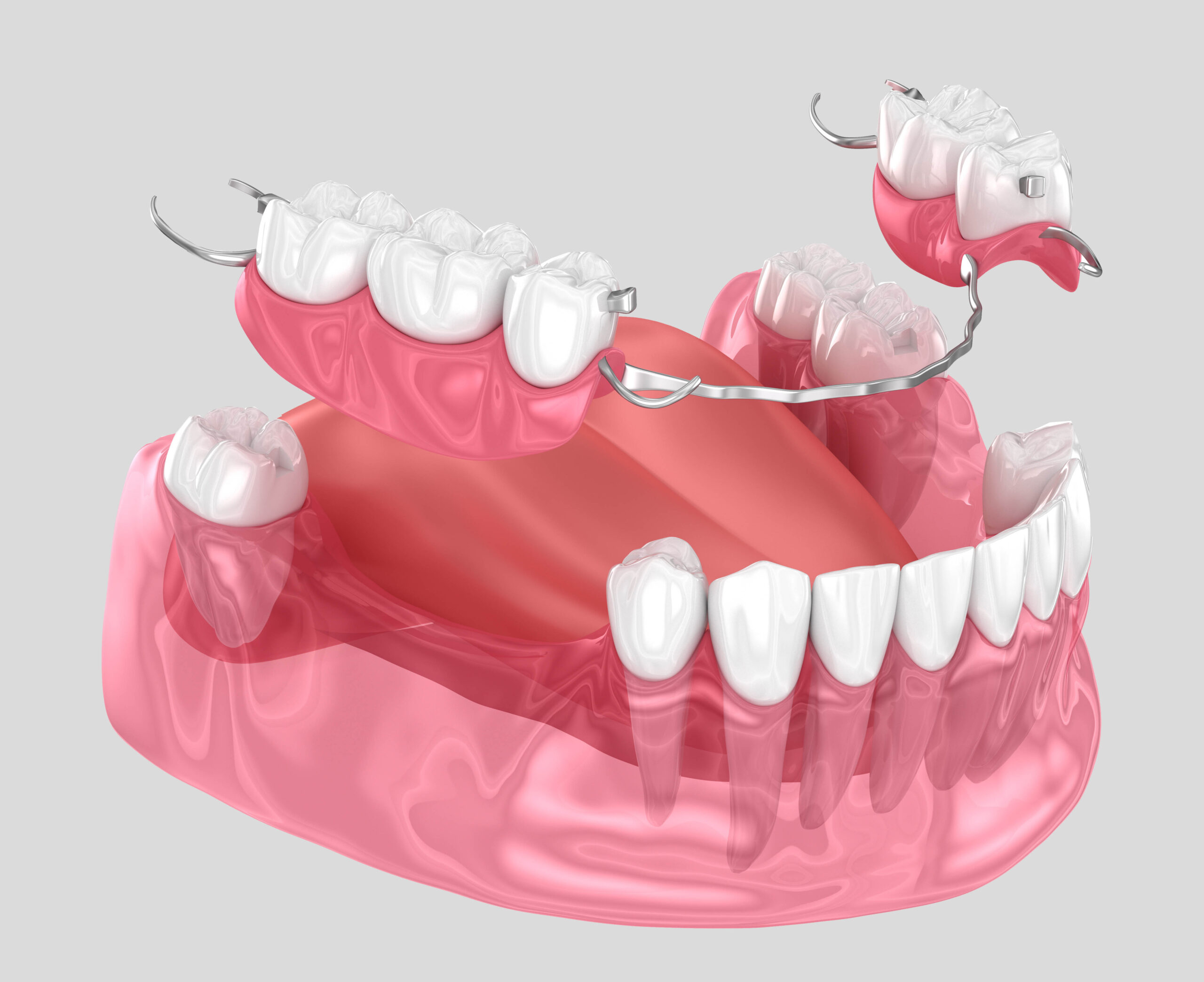 prothèse dentaire amovible