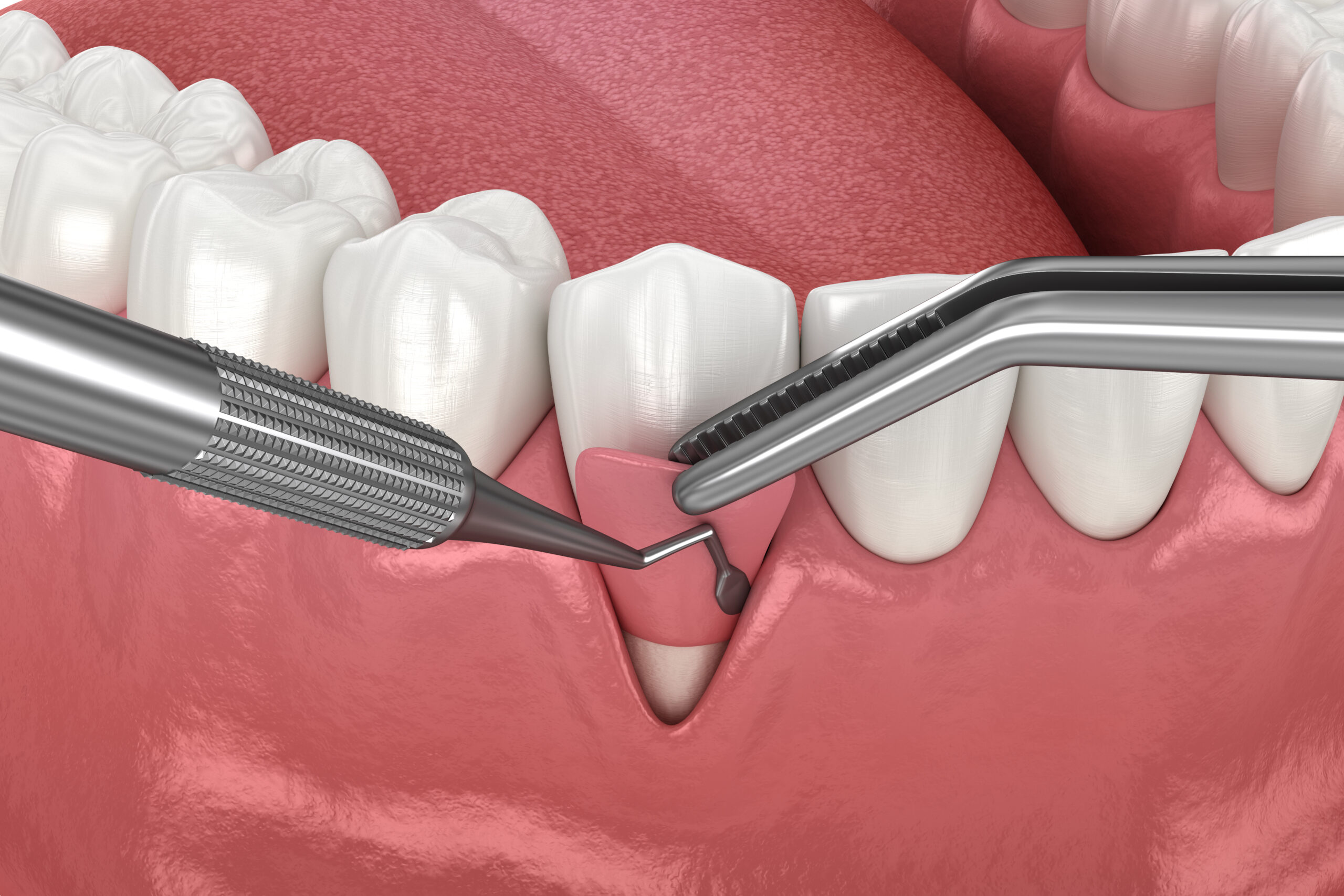 Récession gingivale : Chirurgie de greffe de tissus mous. Illustration 3D d'un traitement dentaire.