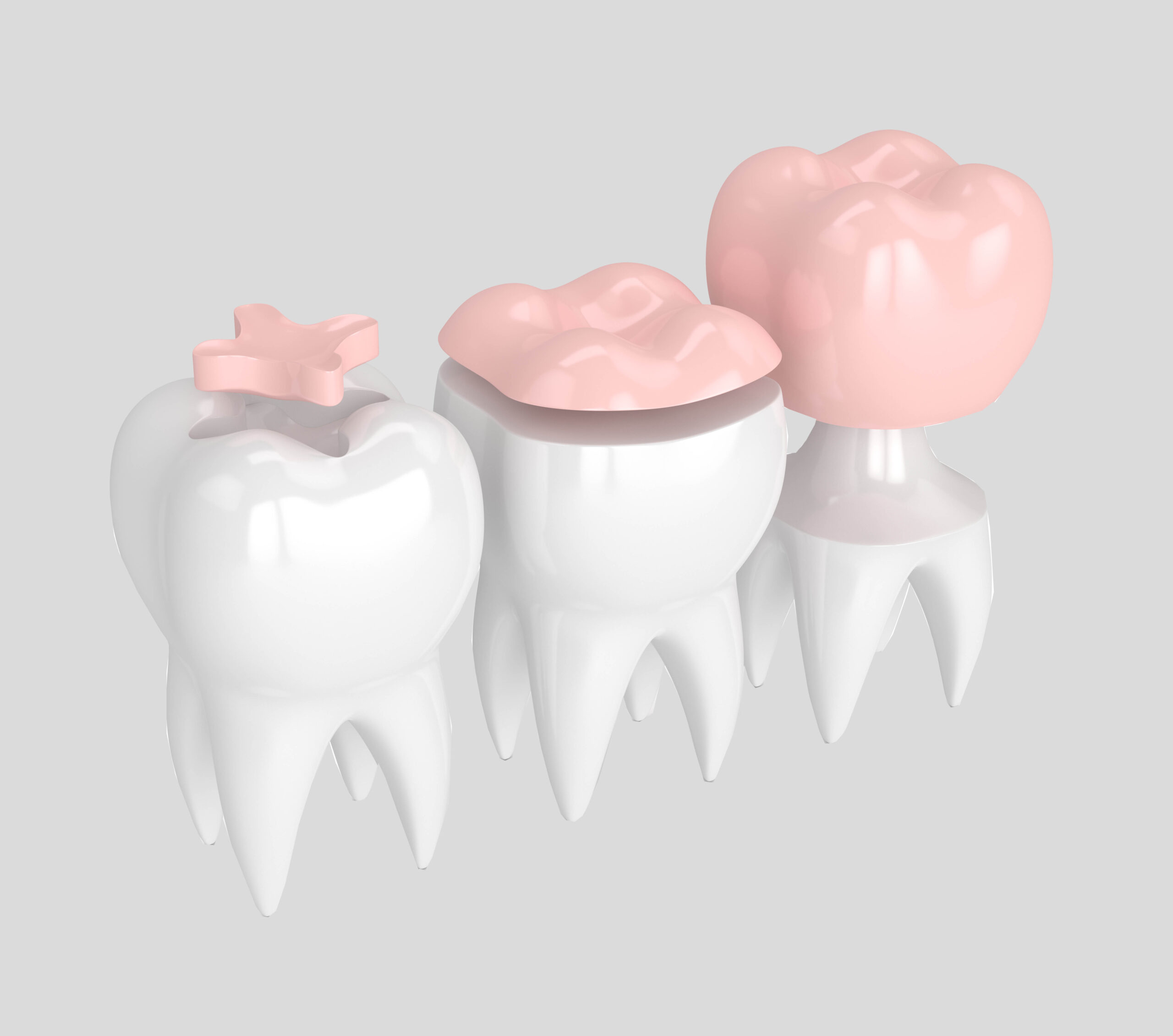 3d render of teeth with inlay, onlay and crown filling over white background