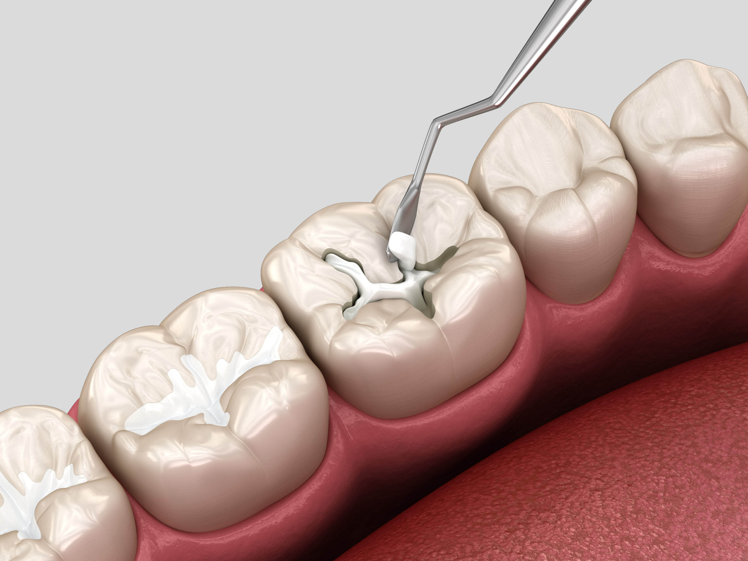 Restauration-dentaire-avec-obturation-composite-__-scellement-sillons-scaled