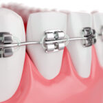 orthodontie, dents avec des bagues