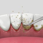 Détartrage du tartre et de la plaque dentaire